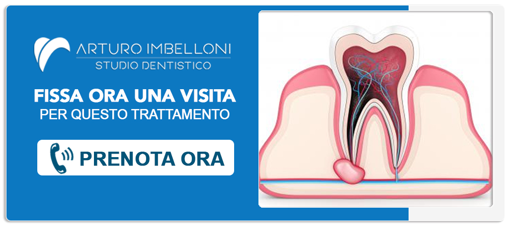 granulomi-e-cisti-dentali Roma (Prati)