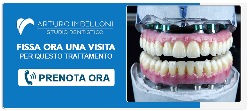 implantologia-all-on-six Roma (Prati)