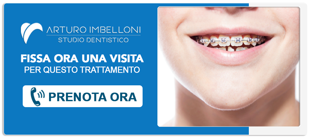 ortodonzia-fissa Roma (Prati)